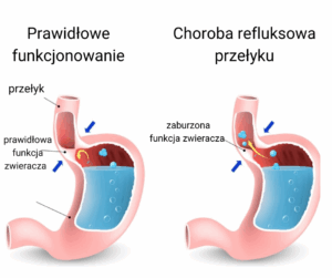 Inhibitory pompy protonowej a refluks 